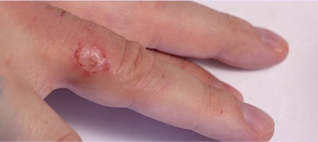 Discoid eczema